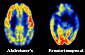 Symptoms: Alzheimer's disease versus frontotemporal dementia (FTD)